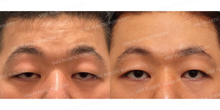 ยกคิ้วผ่านกล้อง (Endoscopic Forehead Lift) + แก้ไขกล้ามเนื้อตาอ่อนแรงแบบกรีด (กรณีกล้ามเนื้อตาอ่อนแรงรุนแรง)