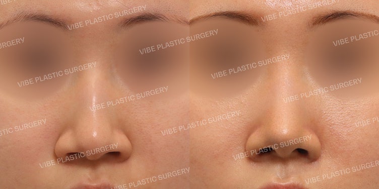 عملية تجميل الأنف المعقوف بدون غرسات وتصغير فتحات الأنف