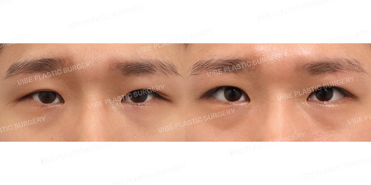 แก้ไขกล้ามเนื้อตาแบบไร้รอยพับสำหรับผู้ชาย (ผ่าตัดซ้ำ)