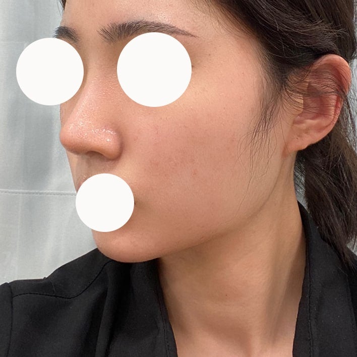 从鼻子到下巴的线条很重要!低鼻整形 & 双下巴吸脂(Liposound) 사진 11