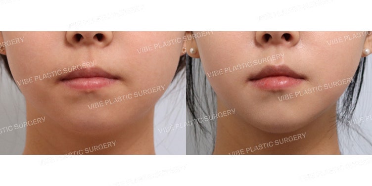 Non-Incisional Facial Liposuction Using Ultrasound!