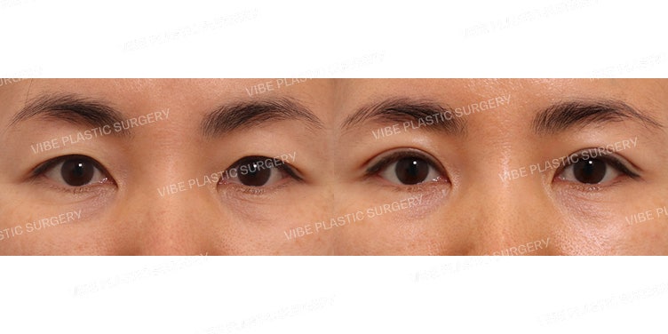 การยึดเกาะแบบธรรมชาติ, การดูดไขมัน LipoSound และการร้อยไหม Silhouette Soft!