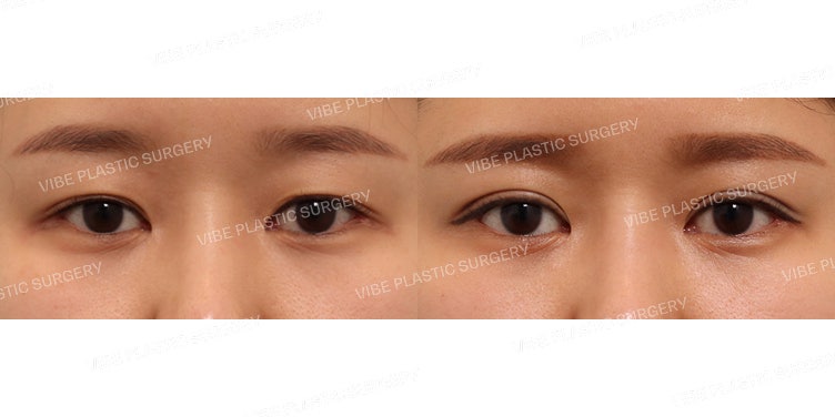 Cắt mí mắt (Phẫu thuật lại)