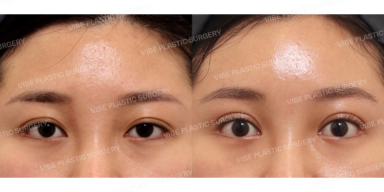 Nâng cung mày nội soi và Chỉnh hình sụp mí thực hiện đồng thời!