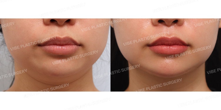 VIBE Liposuction