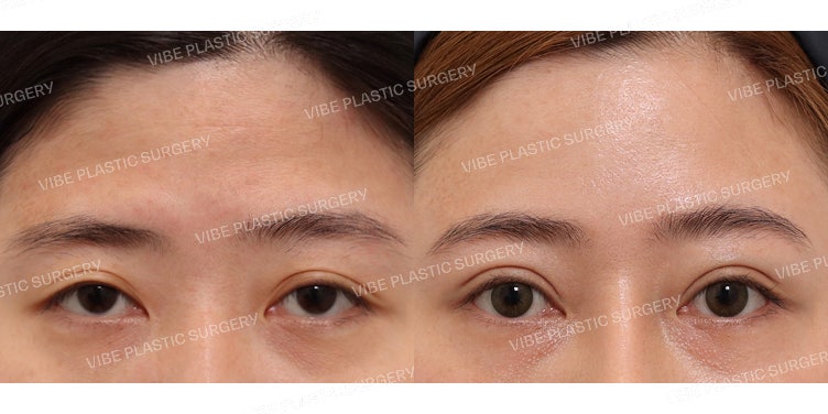 การยกคิ้วผ่านกล้อง (Endoscopic Forehead Lift) & การปรับกล้ามเนื้อตาแบบกรีดจุด (Partial Incision Ptosis Correction)