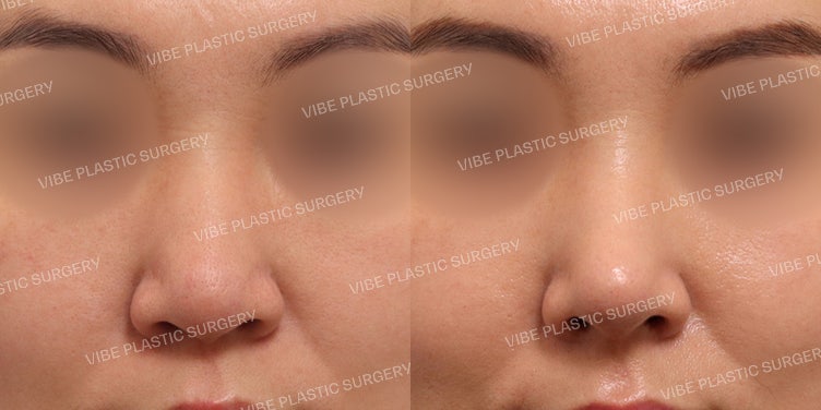 ศัลยกรรมจมูกแบบไม่ใช้ซิลิโคน (No-Implant) ที่ VIBE Plastic Surgery