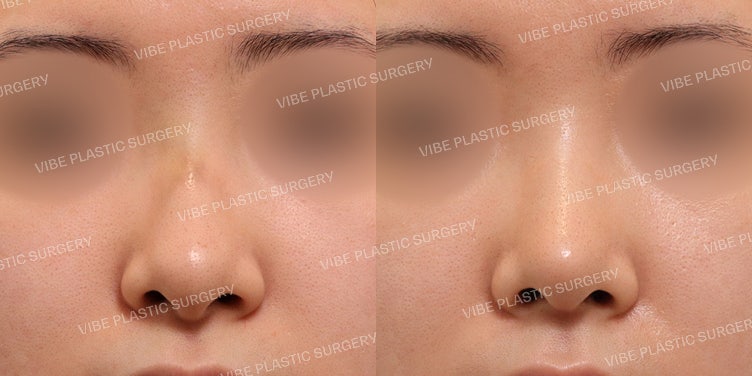 ศัลยกรรมจมูกแบบไร้ซิลิโคน (No-Implant) ที่ VIBE Plastic Surgery