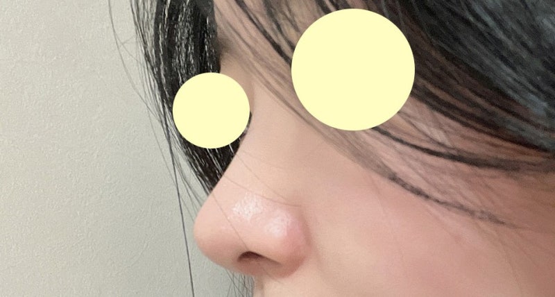 VIBE Plastic Surgery: Non-Implant Rhinoplasty
