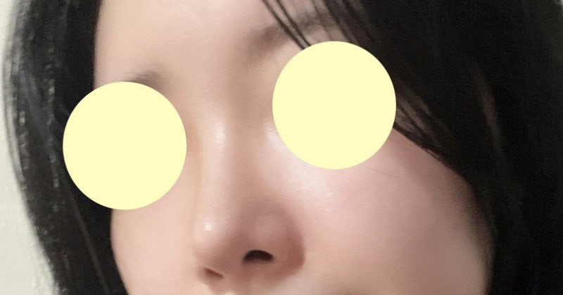 Operasi Hidung Tanpa Implan di VIBE Plastic Surgery 사진 7