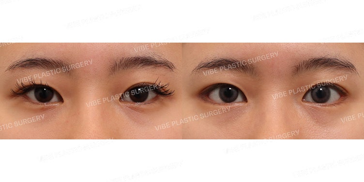 VIBE Mango Canthoplasty (เปิดหางตาและปรับองศาหางตา, Dual Canthoplasty)
