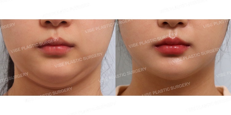 ประสิทธิภาพของการดูดไขมันด้วย LipoSound