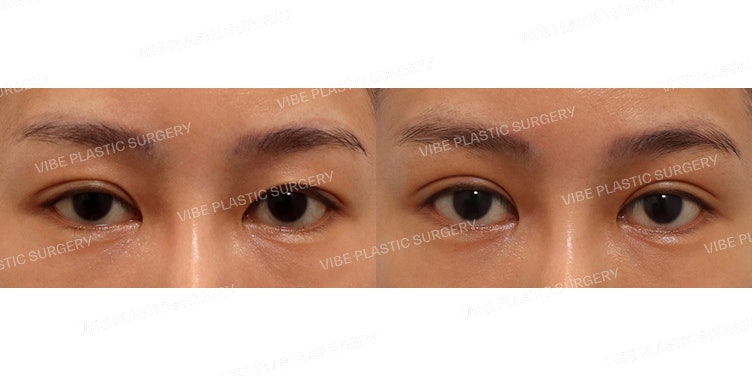 Correcting Asymmetrical Eyes (Non-Incisional Ptosis Correction)