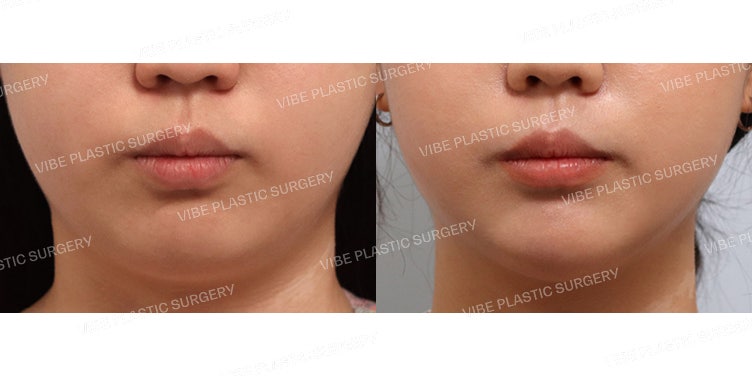 Liposound Liposuction (Garis Rahang, Double Chin)
