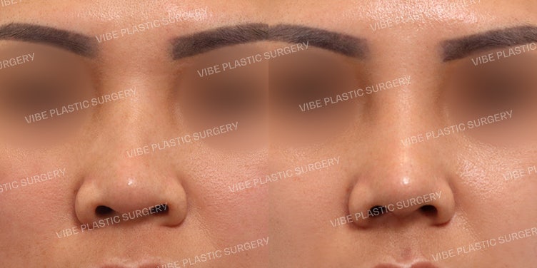 عملية إعادة تجميل الأنف (غرسة L، تصحيح الزاوية الأنفية الشفوية)