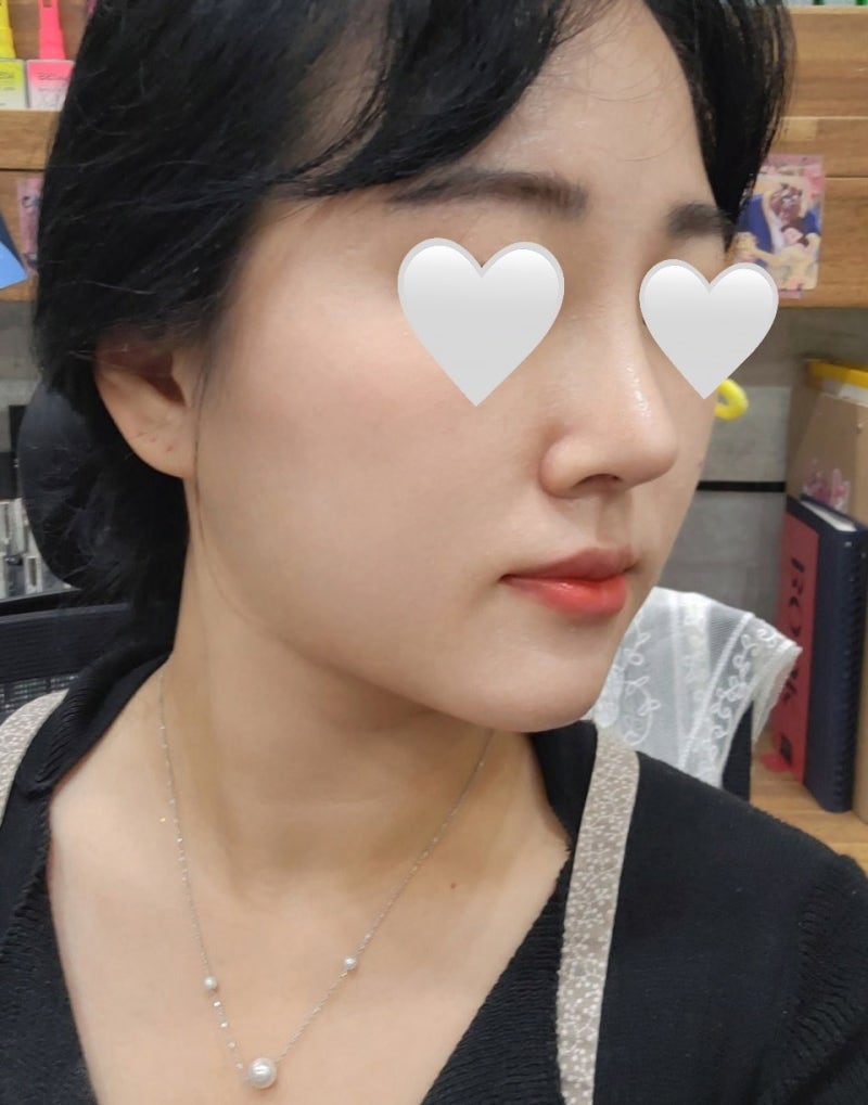 団子鼻&鼻唇角矯正は?VIBE整形外科!! 사진 6