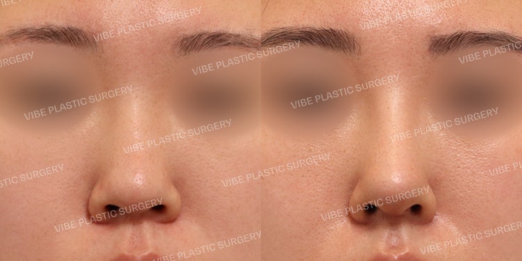 蒜頭鼻與鼻唇角矯正？就在 VIBE 整形外科！！