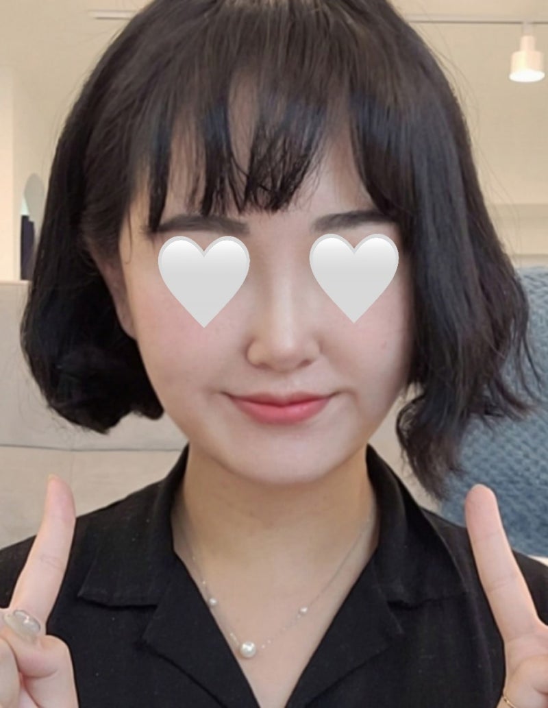団子鼻&鼻唇角矯正は?VIBE整形外科!! 사진 7