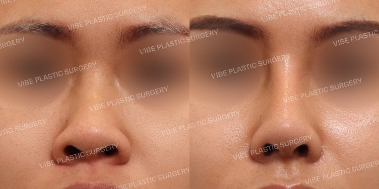 Operasi Hidung Pendek & Hidung Lebar (Bulbous Nose)