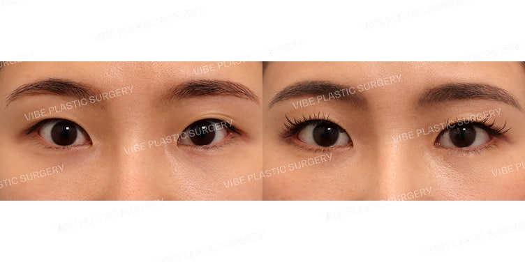 ปรับลุคให้ดูละมุนด้วยการทำ Dual Canthoplasty (เปิดหางตาและปรับระดับหางตา) !!