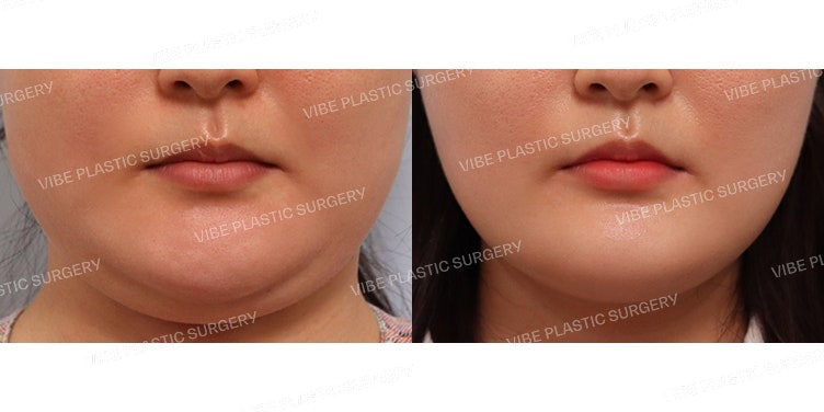 Atasi Double Chin dengan LipoSound!