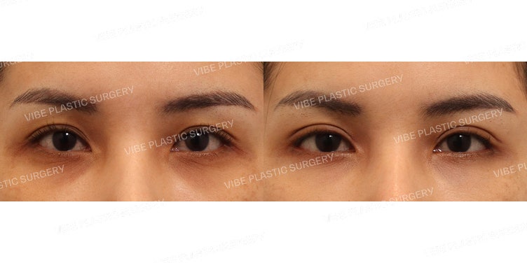 Kelopak Mata Ganda Insisi & Lateral-Lower Canthoplasty !!