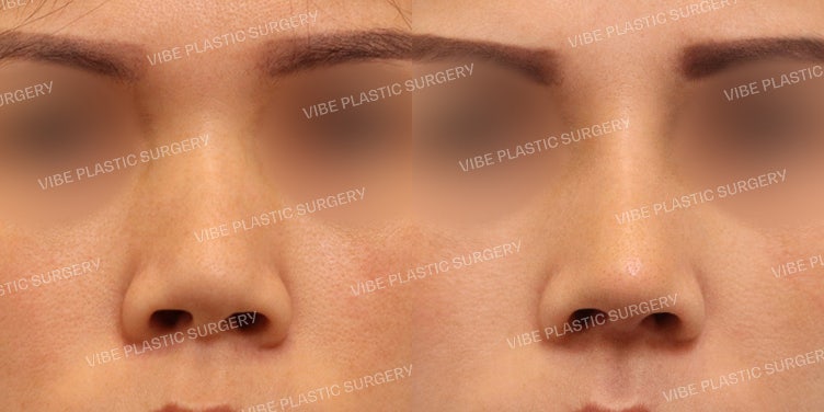 ศัลยกรรมจมูกสั้นที่ VIBE Plastic Surgery
