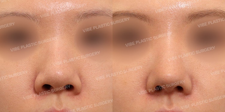 جراحة تجميل الأنف العريض بدون غرسات في عيادة فايب للتجميل!