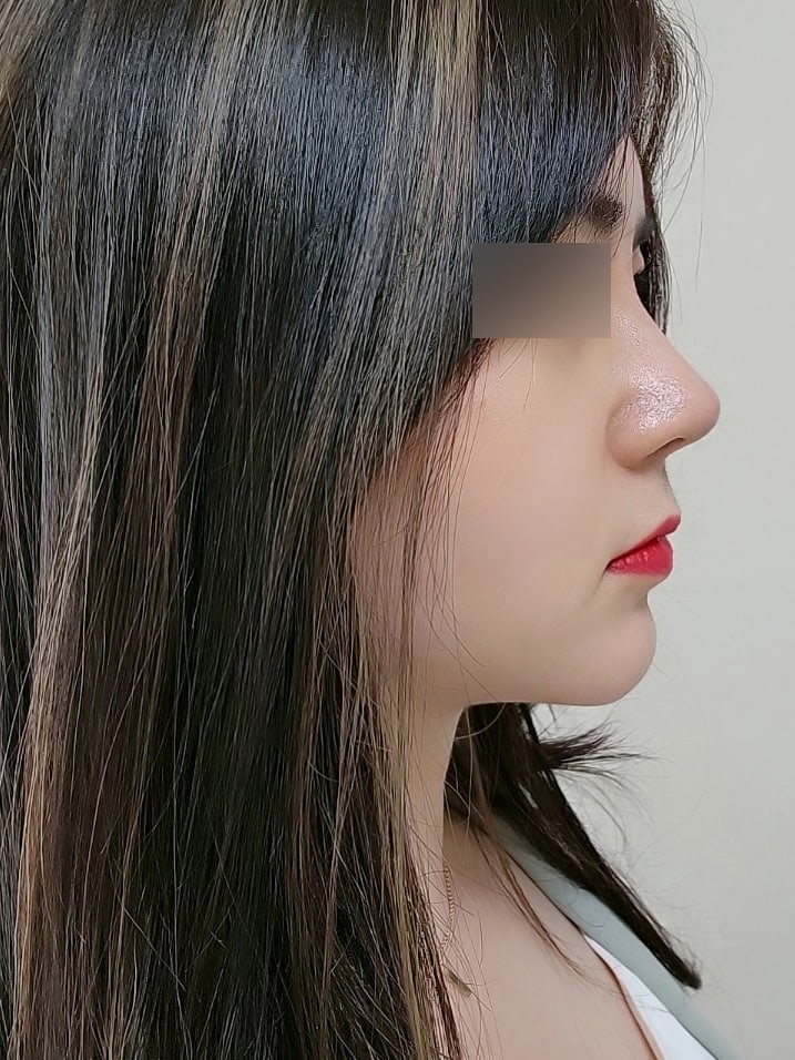جراحة تجميل الأنف البارزة في عيادة فايب للتجميل :) 사진 7