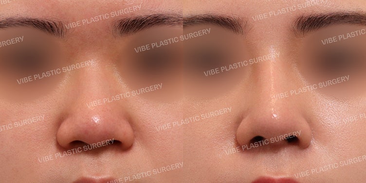 VIBE Plastic Surgery's Natural yet Glamorous Bulbous Nose Rhinoplasty :)