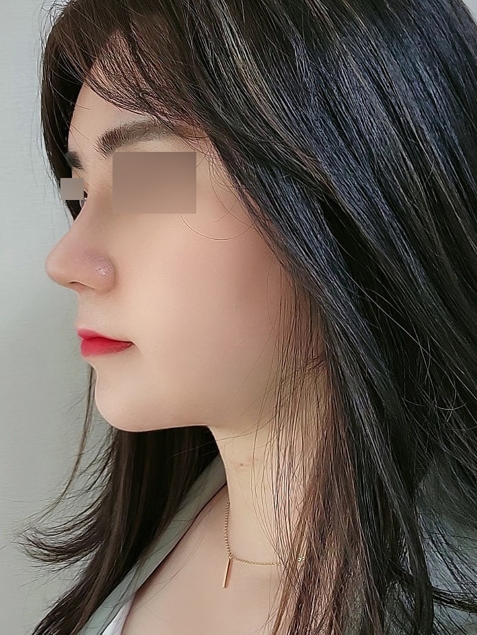 جراحة تجميل الأنف البارزة في عيادة فايب للتجميل :) 사진 8