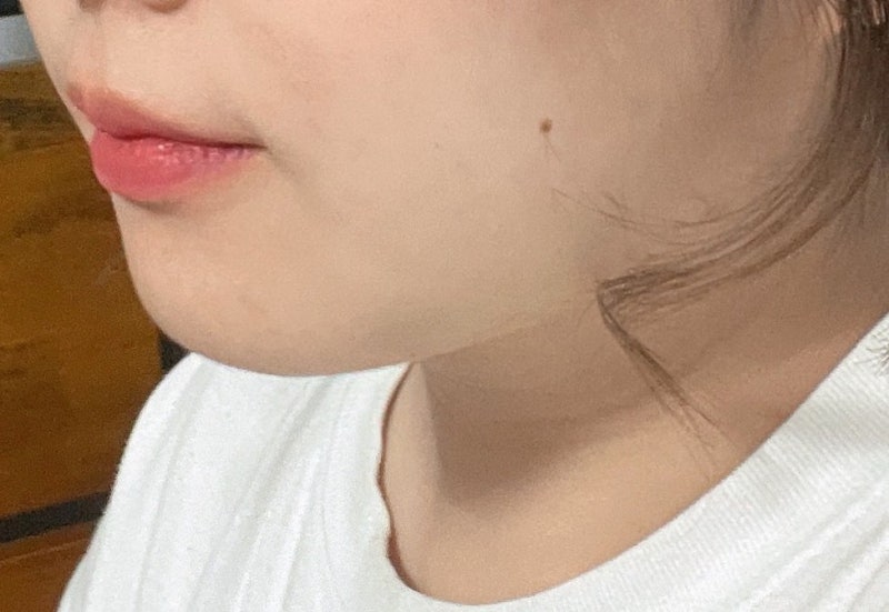 تأثير شفط دهون الوجه بالليبو ساوند في عيادة فايب للتجميل! 사진 6