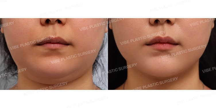 Hút mỡ LipoSound :D