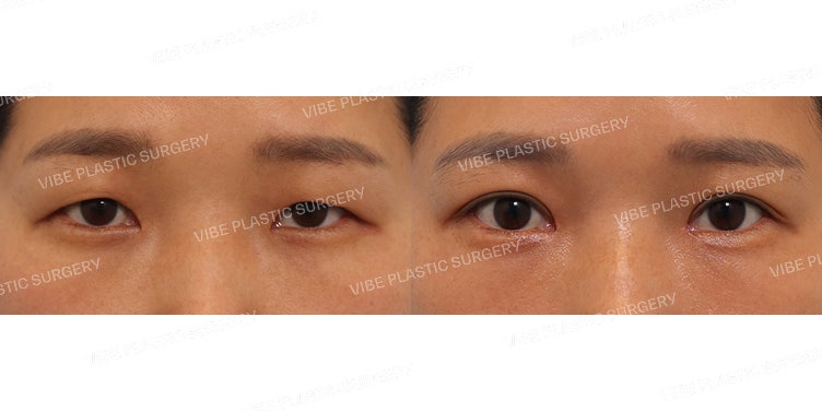 ศัลยกรรมตาสองชั้นบนพร้อมแก้ไขกล้ามเนื้อตา (Upper Blepharoplasty & Ptosis Correction) !