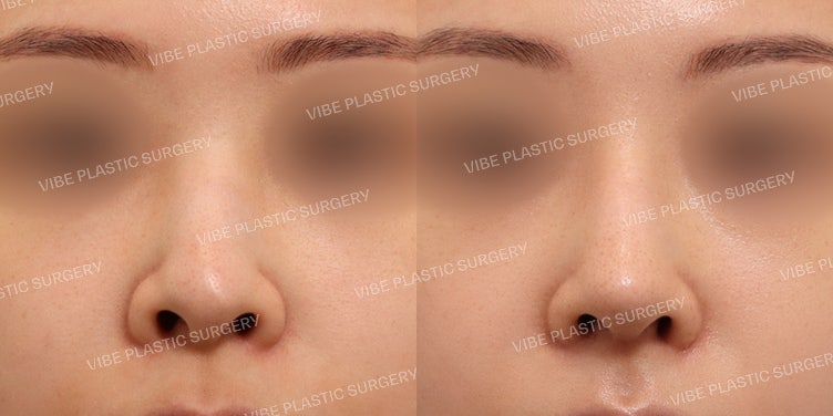 Bulbous Nose & Nostril Correction