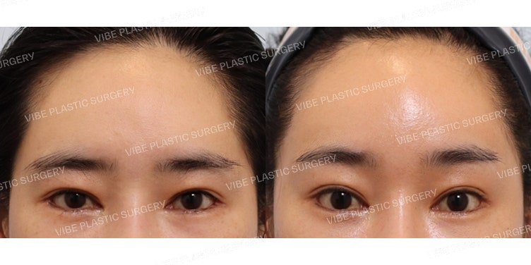 ศัลยกรรมดึงหน้าผากผ่านกล้องส่องตรวจ (Endoscopic Forehead Lift)