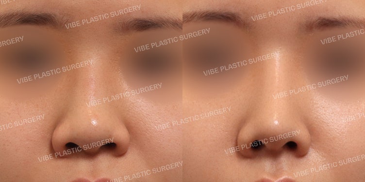 ศัลยกรรมจมูกปลายหนา (Bokko) ที่ Vibe Plastic Surgery!