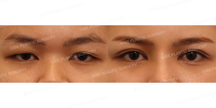 การแก้ไขกล้ามเนื้อตาแบบกรีด (Incisional Ptosis Correction) โดย VIBE Plastic Surgery