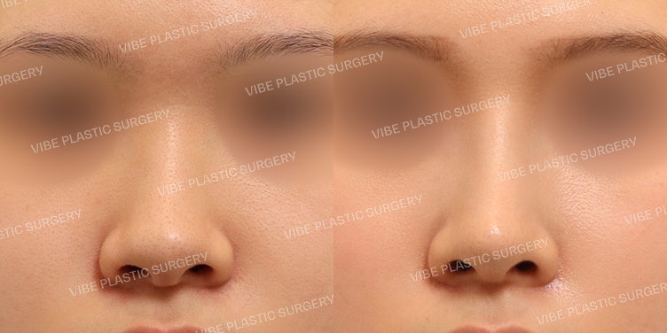 Transformasi Luar Biasa Hidung Pesek dan Lebar (Bulbous Nose)!