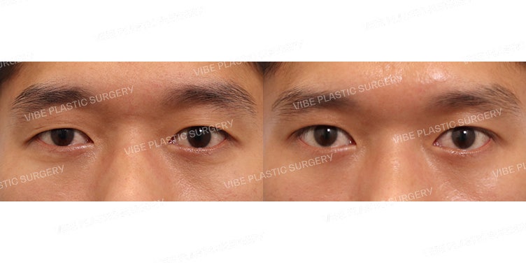 Chỉnh sửa sụp mí mắt nam tại Thẩm mỹ viện Vibe!