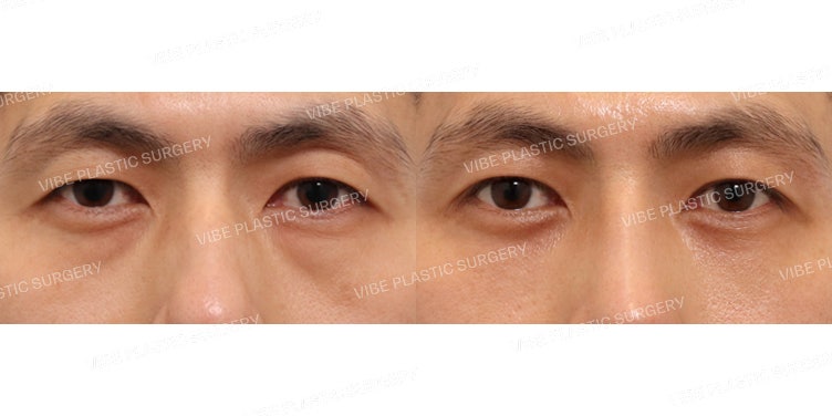 Chỉnh hình sụp mí không cắt tầng & Tái cấu trúc mỡ dưới mắt cho nam giới