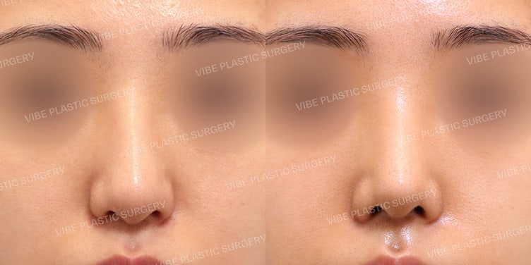 تحقيق خط الأنف المستقيم والمنحني (Straight-Semi-curved) بأسلوب كارينا بدون غرسات صناعية!