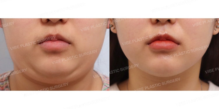 Vibe Plastic Surgery: ผู้เชี่ยวชาญด้าน LipoSound แห่งย่านคังนัม! :D