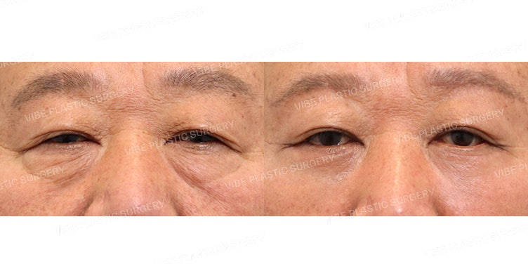 中年男性の目元整形はナチュラルに！