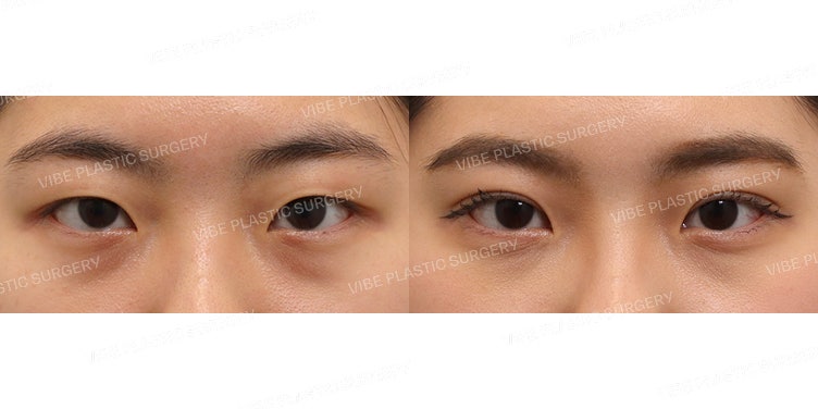 Partial Incision Ptosis Correction!