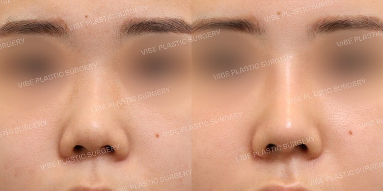 การเปลี่ยนแปลงครั้งใหญ่ของจมูกที่หนาและสั้น!! ที่ VIBE Plastic Surgery เท่านั้น!