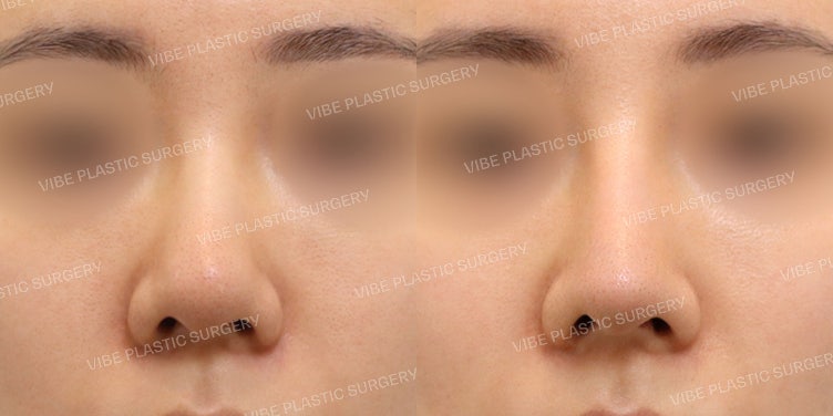 إعادة جراحة الأنف العريض (Bulbous Nose) في عيادة فايب للتجميل!