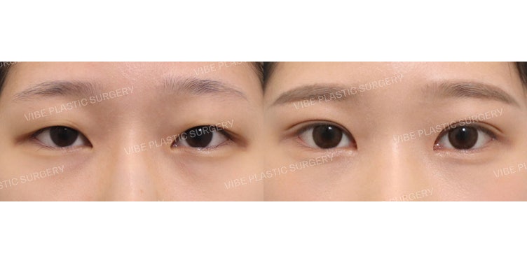 ดวงตาสวยเป็นธรรมชาติด้วยเทคนิคกรีดสั้น (Partial Incision) :D