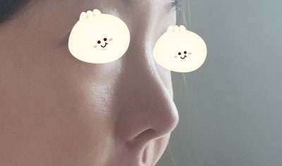 ไม่อยากใช้ซิลิโคน! ศัลยกรรมจมูกแบบไร้ซิลิโคน :D 사진 8