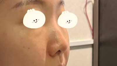I don't want implants! Implant-Free Rhinoplasty :D